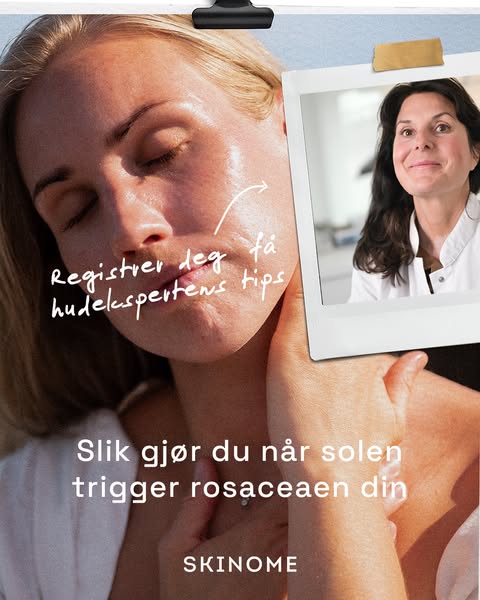An image ad for the brand Skinome with tips to help with Rosacea when it is triggered by the sun.