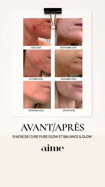 This ad shows before-and-after photos of someone's skin after using the Aime 6-month Pure Glow et Balance & Glow