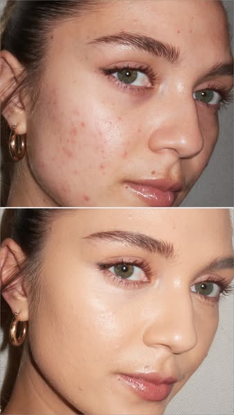 This ad shows a before and after of a woman's face with acne before and after using a product.
