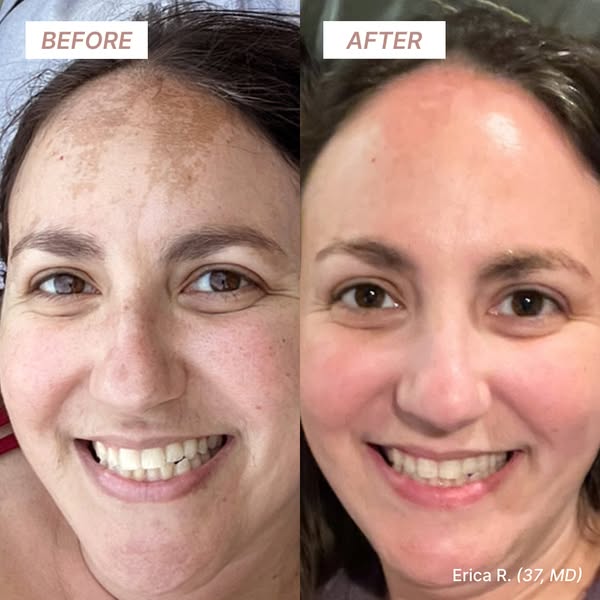 This ad shows a before and after photo of a woman's face. The before photo shows dark spots on her forehead and face