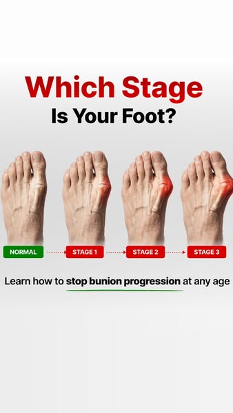 This ad highlights the stages of bunion progression and encourages viewers to learn how to stop bunion progression at an