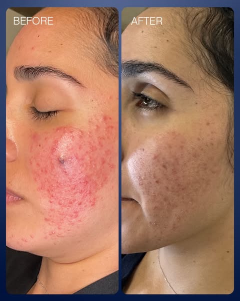 PCA SKIN ad