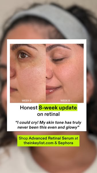 This image ad shows a woman's face in before and after photos to demonstrate the effects of a retinal product after 