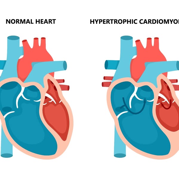 This is a comparison ad that displays two images of a normal heart and a heart with hypertrophic cardiomyopathy.