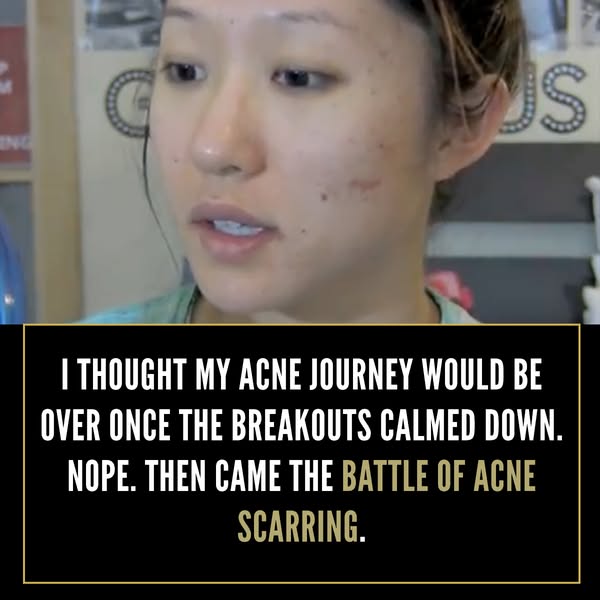 This ad presents a skincare issue that many people who suffer from acne may face, which is acne scarring. The ad display