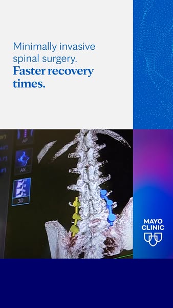 This ad by Mayo Clinic promotes minimally invasive spinal surgery with faster recovery times. It features a 3D rendering