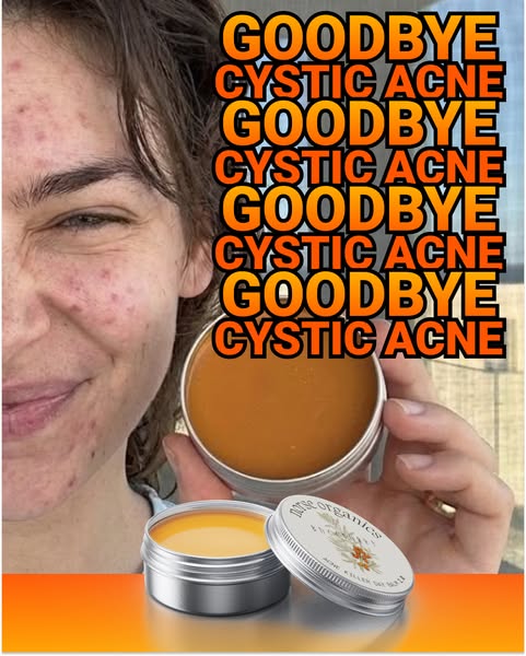 This image ad aims to promote Norse Organics Acne Killer Day Salve as an effective solution for cystic acne. It uses a b