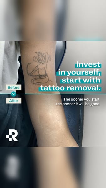 This ad uses a before-and-after split screen to show the results of tattoo removal.