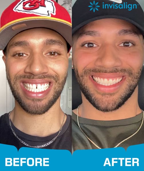 This image ad is designed to showcase the transformative results of using Invisalign aligners. The ad features a split-s