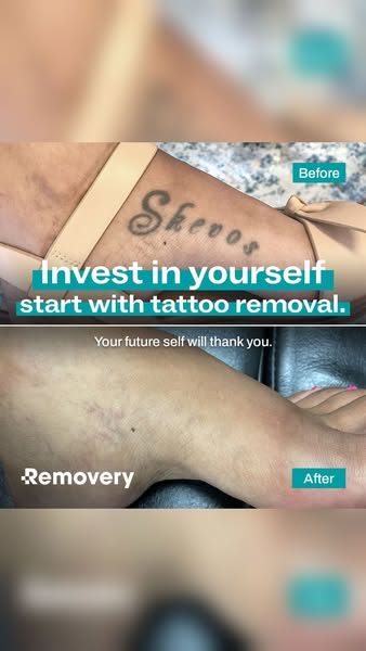 This image ad shows the results of tattoo removal services from Removery using a before and after split screen. The top 