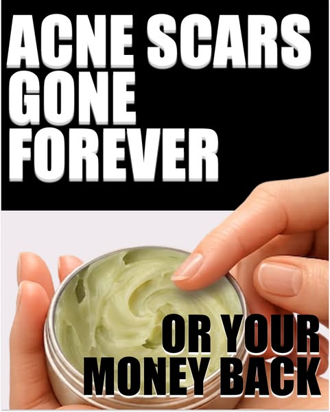 This image ad promotes a skincare product designed to eliminate acne scars. It features a close-up of a person's fin