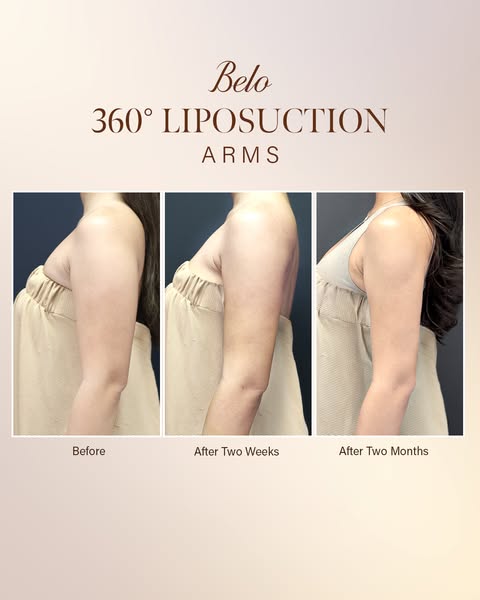 The ad shows before and after photos of a woman's arm after a 360° liposuction. The 'before' photo shows the