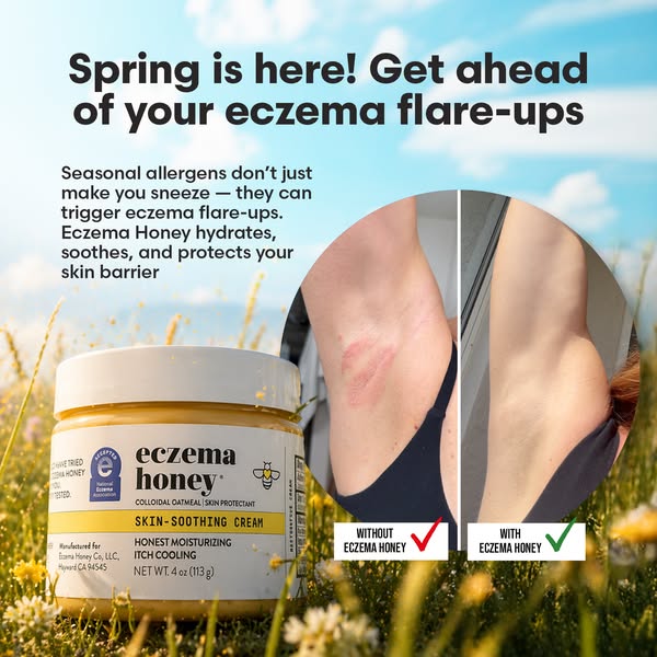 This ad promotes Eczema Honey cream as a solution to eczema flare-ups, especially during the spring season when allergen
