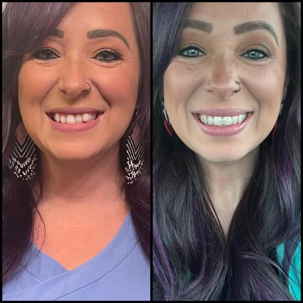 This ad shows a before and after image of a woman's teeth, presumably after using a teeth whitening product.