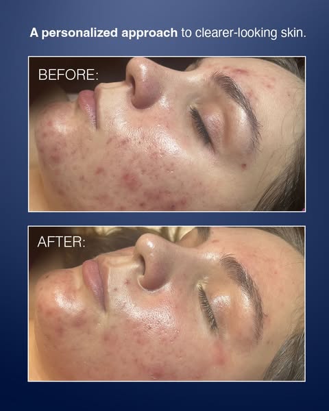 PCA SKIN ad