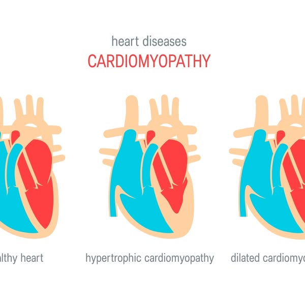 This is an informational ad that shows three different types of heart disease, cardiomyopathy. The ad presents healthy h