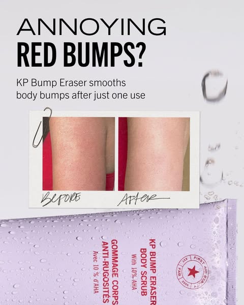 This ad for KP Bump Eraser features a before-and-after photo demonstrating how well the product works to smooth skin and