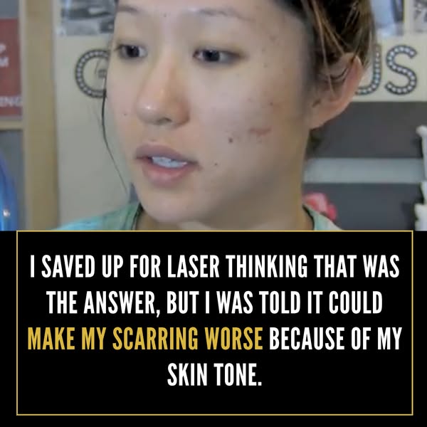This ad features a person discussing how they saved up to get laser treatment for their skin. They were told it would ma
