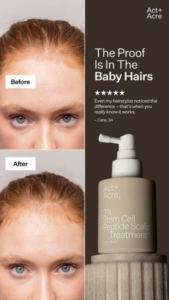 Image ad featuring a before and after photo showcasing hair growth on a woman's hairline as well as a product shot o