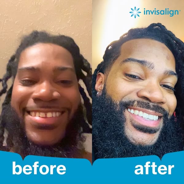 This ad shows a before and after photo of a man's teeth after using Invisalign. The ad aims to show how Invisalign c