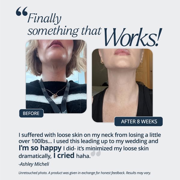 This ad uses a before and after photo to showcase how a product can help with loose skin on the neck. A testimonial adds