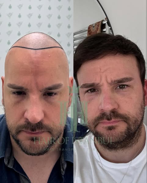 This ad shows a split-screen before-and-after photo of a man who has received a hair transplant at Hair of Istanbul, sho