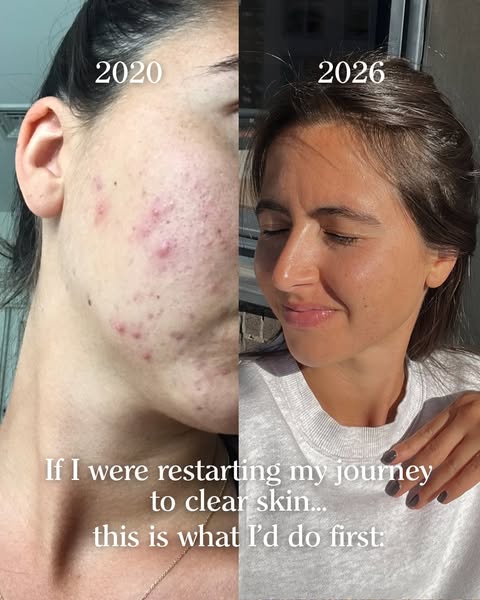This ad shows a woman's face with acne in 2020 on the left and her face with clear skin in 2026 on the right. The te