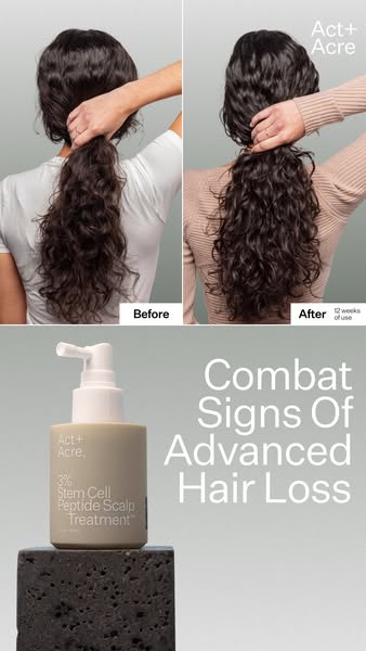 This ad promotes Act+Acre's 3% Stem Cell Peptide Scalp Treatment using a split before and after image to showcase ha