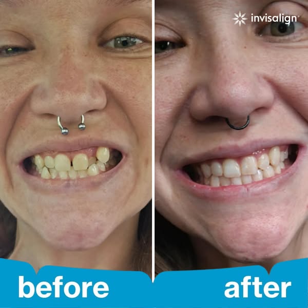This ad shows a before and after photo of a person's teeth after using Invisalign. The ad highlights the visible imp