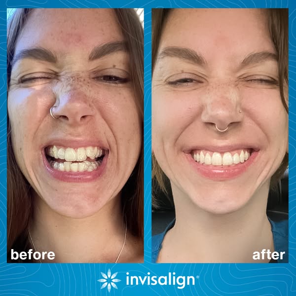 This ad shows a before and after photo of a woman's teeth after using Invisalign. The before photo shows the woman s
