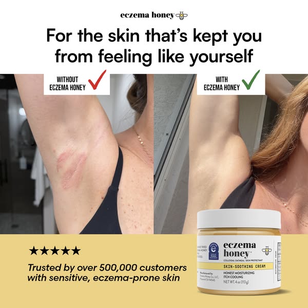 This ad for Eczema Honey features a before-and-after shot of a person's armpit with eczema. On the left, the armpit 