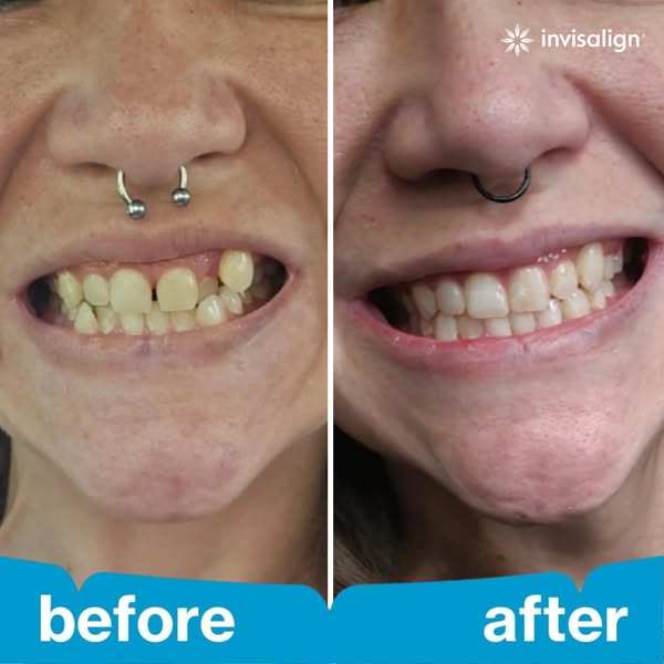 This ad features a split-screen visual of a woman's teeth 'before' and 'after' using Invisalign. The