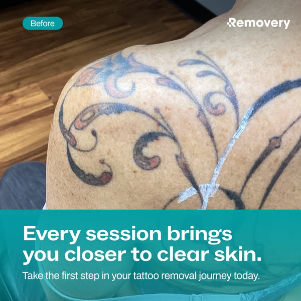 The ad shows a shoulder with a tattoo in a 'before' state, and then shows a close-up of a tattoo during the remo
