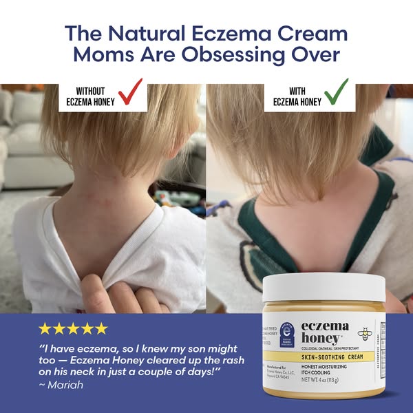 This image ad for Eczema Honey features a before-and-after style visual along with a positive testimonial from a mother 