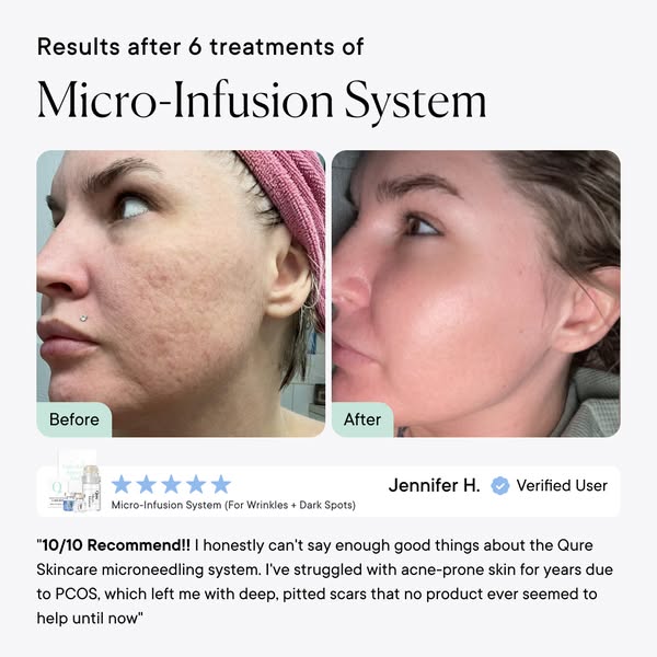 This ad showcases the Qure Skincare microneedling system and its effectiveness in treating acne-prone skin with deep, pi
