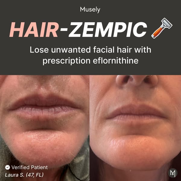 This ad shows a before and after image of a woman's chin and mouth area with and without hair. The text claims that 