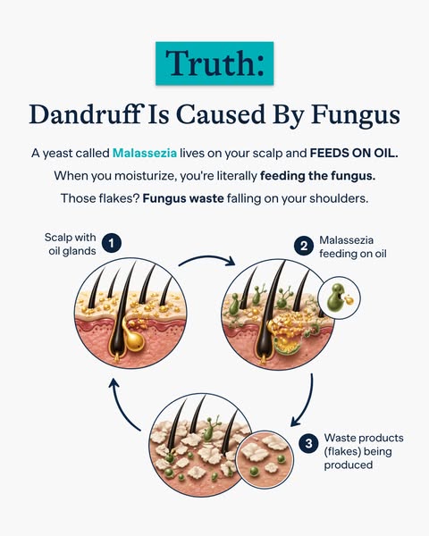 The ad explains that dandruff is caused by fungus that lives on the scalp and feeds on oil. The ad shows through a circu