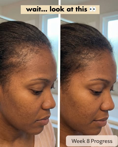 This image ad displays a before and after shot of a woman's hairline, showing the progression of hair growth after 8