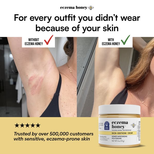 This ad compares a woman's underarm skin with and without eczema using the Eczema Honey skin soothing cream. The ad&
