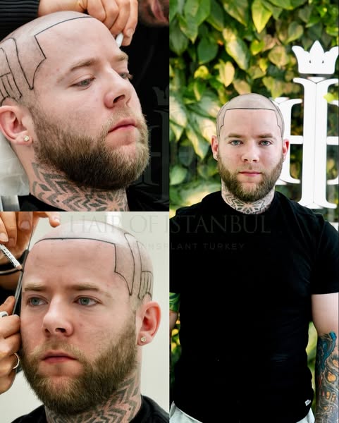 This image ad uses a split-screen before and after to showcase the results of a hair transplant procedure from Hair of I