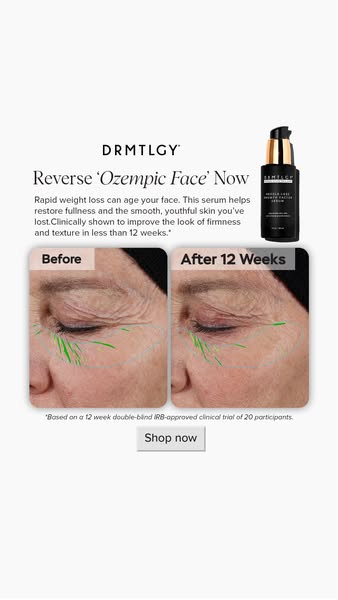 This ad presents the DRMTLGY Double-Lox Growth Factor Serum as a solution to 'Ozempic face', showcasing before a