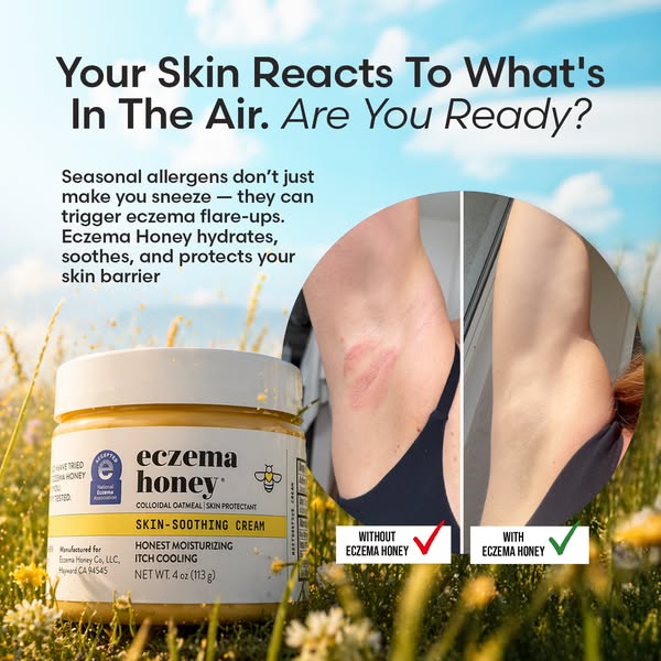 This image ad for Eczema Honey aims to demonstrate that those who suffer from eczema flare-ups during allergy season can