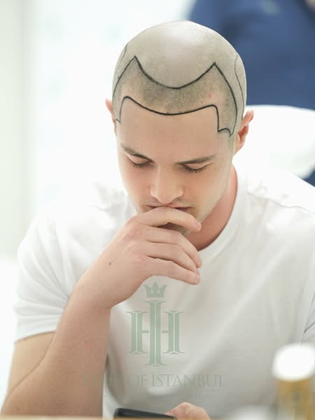 This ad features an image of a man's head with a scalp micropigmentation treatment, showing the hairline design befo