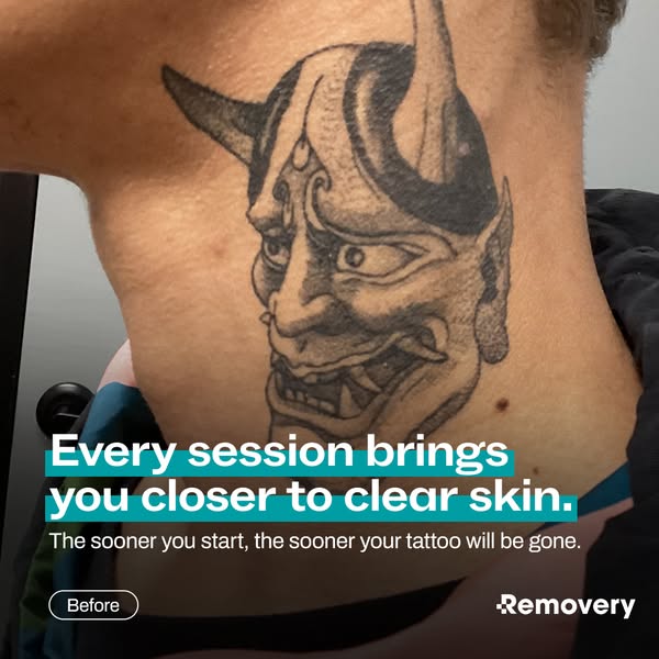 This ad is for Removery and it shows a person with a tattoo on their neck that they want to get removed.